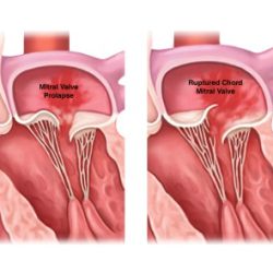 Match the following term with its correct description mitral valve