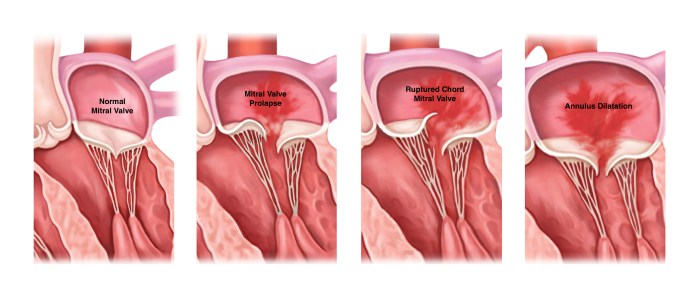 Match the following term with its correct description mitral valve