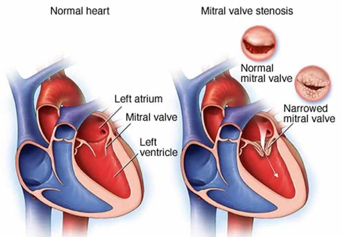 Match the following term with its correct description mitral valve